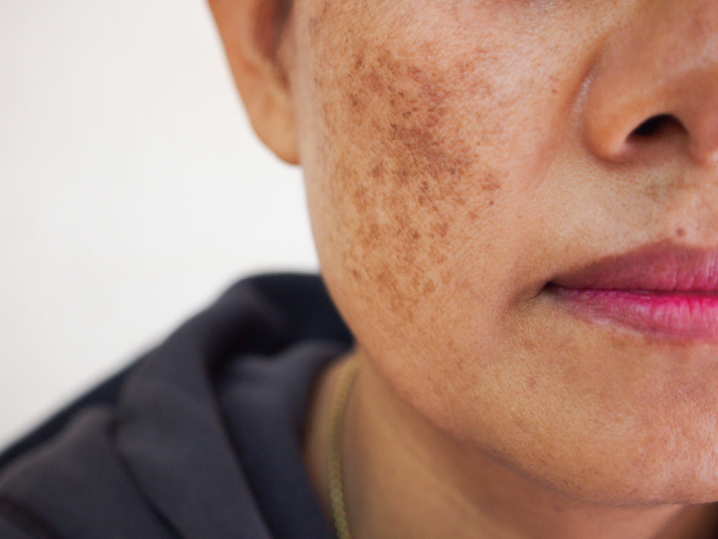 red light therapy for dark spots