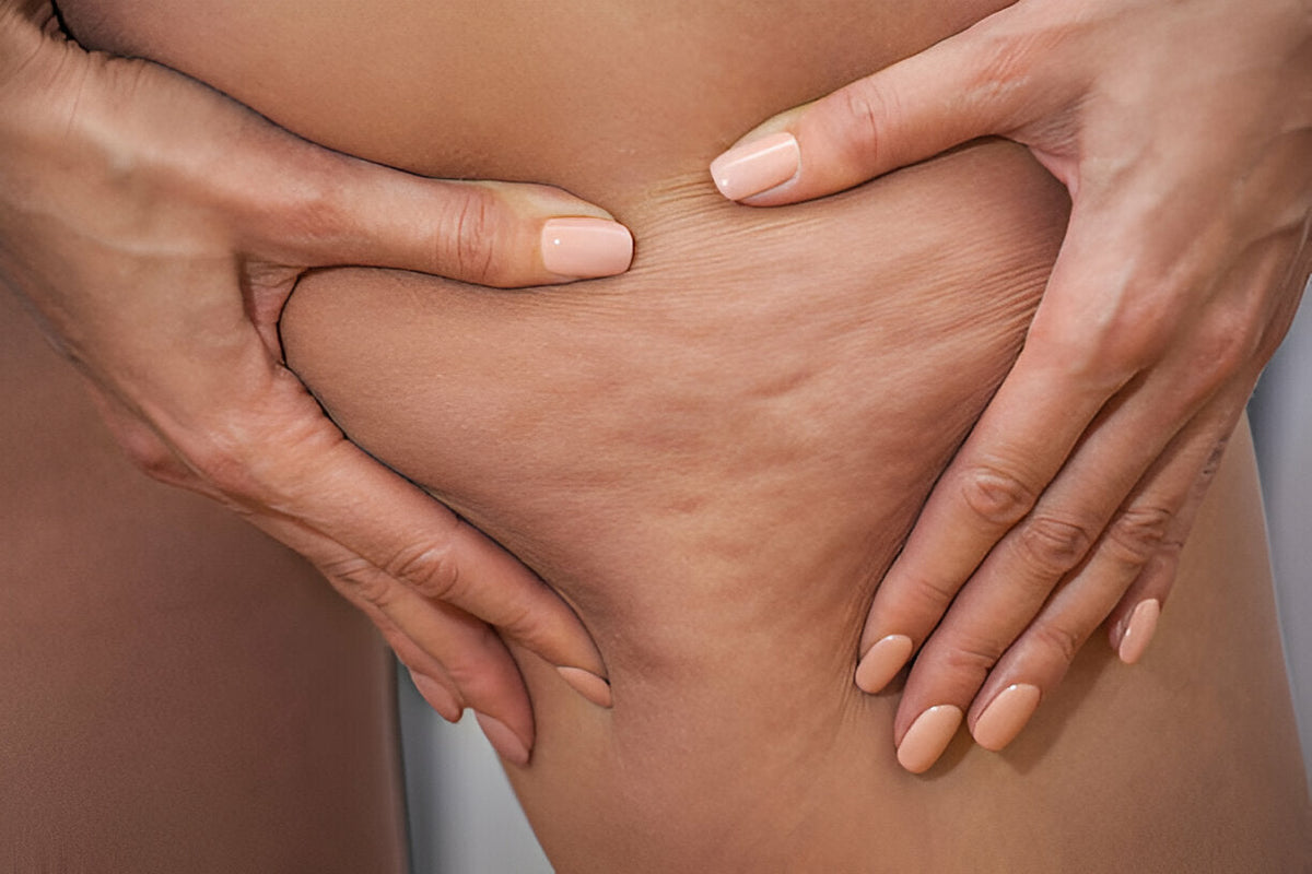 red light therapy for cellulite